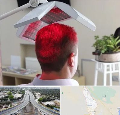 کاشت مو با لیزر در اندیمشک