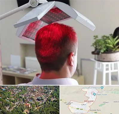 کاشت مو با لیزر در دماوند