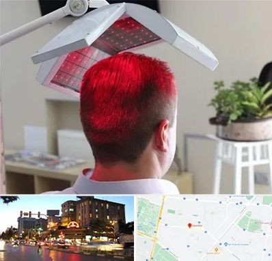 کاشت مو با لیزر در بلوار سجاد مشهد 