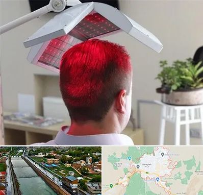 کاشت مو با لیزر در مراغه