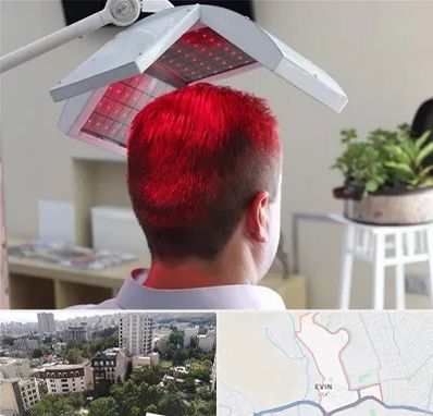 کاشت مو با لیزر در اوین