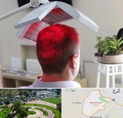 کاشت مو با لیزر در مهرشهر کرج 