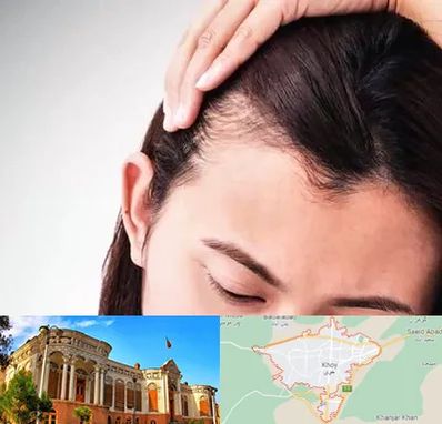 کاشت مو بانوان در خوی