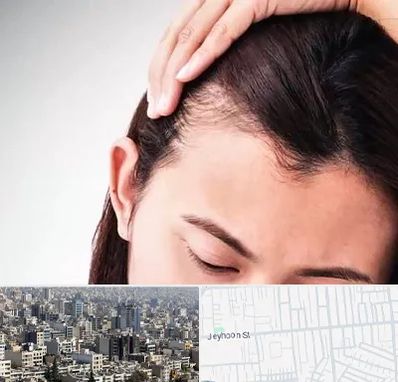 کاشت مو بانوان در جیحون