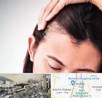 کاشت مو بانوان در پونک 