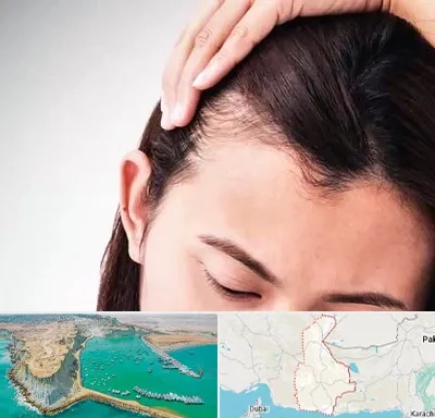 کاشت مو بانوان در سیستان و بلوچستان
