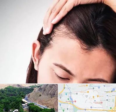 کاشت مو بانوان در کن 