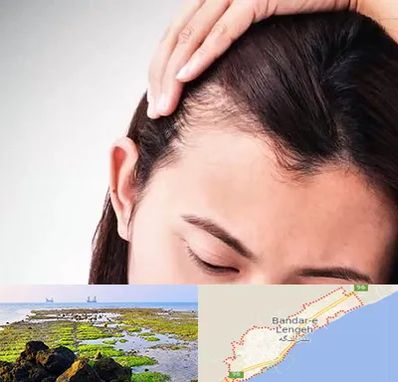 کاشت مو بانوان در بندرلنگه