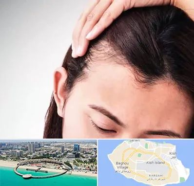 کاشت مو بانوان در کیش