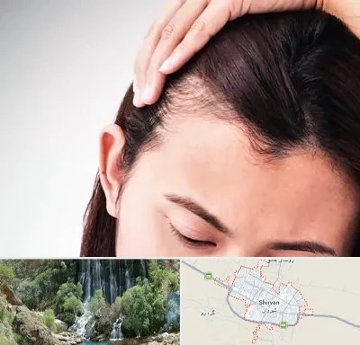 کاشت مو بانوان در شیروان