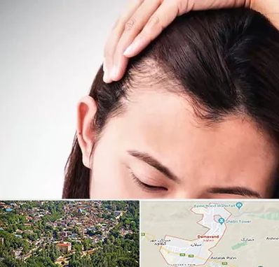 کاشت مو بانوان در دماوند