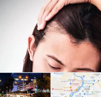 کاشت مو بانوان در کیانپارس اهواز