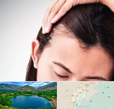 کاشت مو بانوان در رودبار