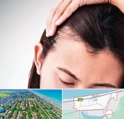 کاشت مو بانوان در نور