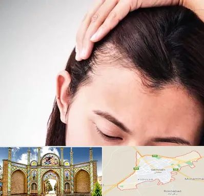 کاشت مو بانوان در سمنان