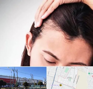 کاشت مو بانوان در فاز دو اندیشه