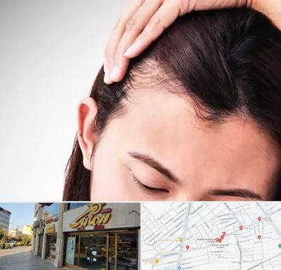 کاشت مو بانوان در عطاران قم