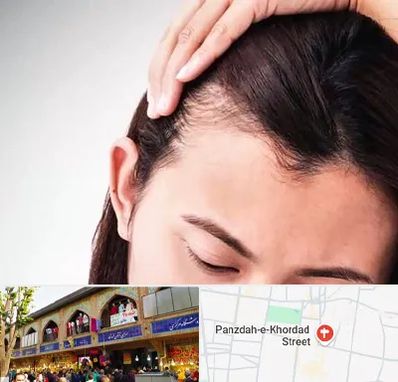 کاشت مو بانوان در 15 خرداد