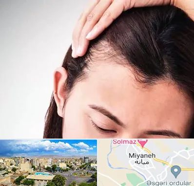 کاشت مو بانوان در میانه