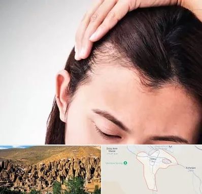 کاشت مو بانوان در اسکو