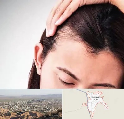 کاشت مو بانوان در اسفراین