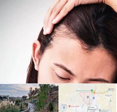 کاشت مو بانوان در باغستان کرج