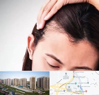 کاشت مو بانوان در المپیک 