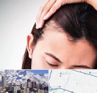 کاشت مو بانوان در ازگل