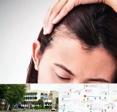 کاشت مو بانوان در طالقانی 