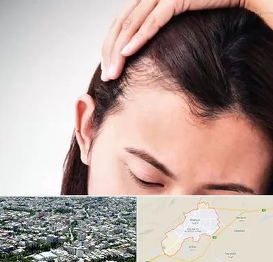کاشت مو بانوان در شاهرود