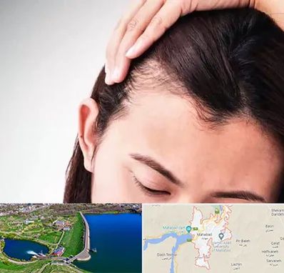 کاشت مو بانوان در مهاباد