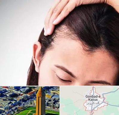 کاشت مو بانوان در گنبد کاووس
