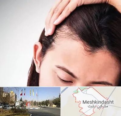 کاشت مو بانوان در مشکین دشت