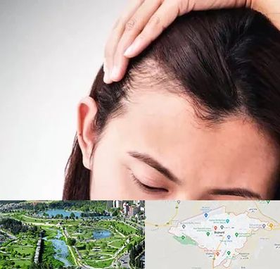 کاشت مو بانوان در بجنورد