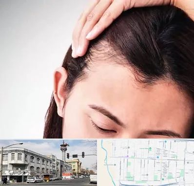 کاشت مو بانوان در 17شهریور