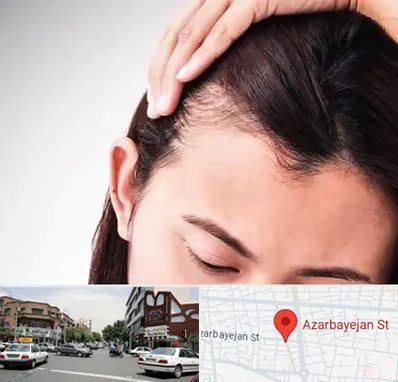 کاشت مو بانوان در خیابان آذربایجان