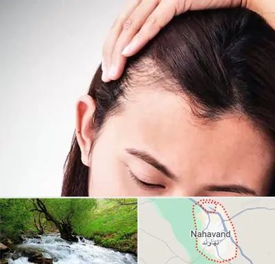 کاشت مو بانوان در نهاوند