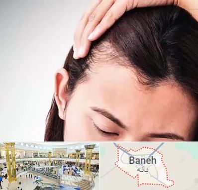 کاشت مو بانوان در بانه