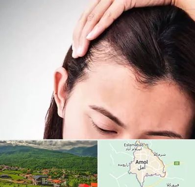 کاشت مو بانوان در آمل