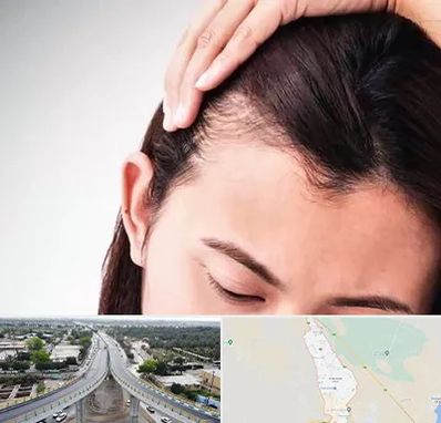 کاشت مو بانوان در اندیمشک