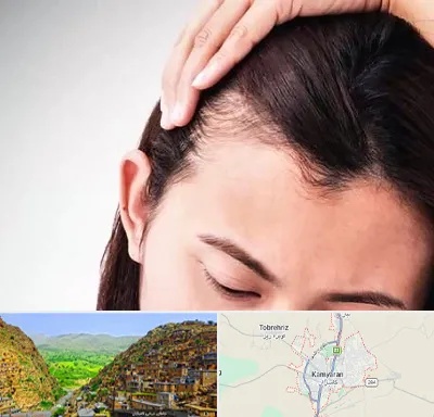 کاشت مو بانوان در کامیاران