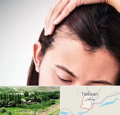 کاشت مو بانوان در طالقان