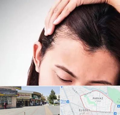 کاشت مو بانوان در پرواز تبریز