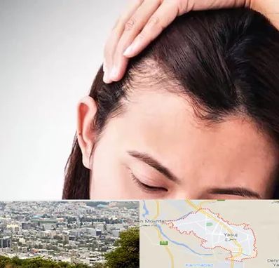 کاشت مو بانوان در یاسوج