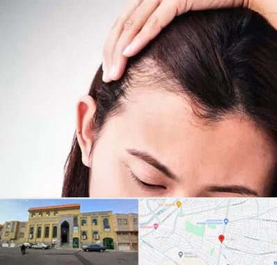 کاشت مو بانوان در زنبیل آباد قم