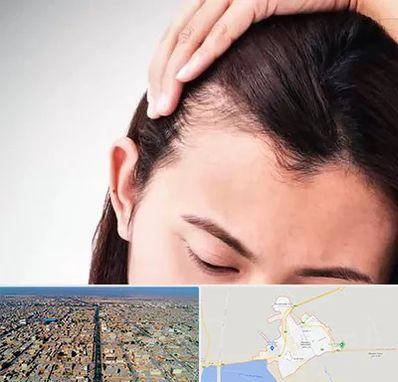 کاشت مو بانوان در بندر ماهشهر