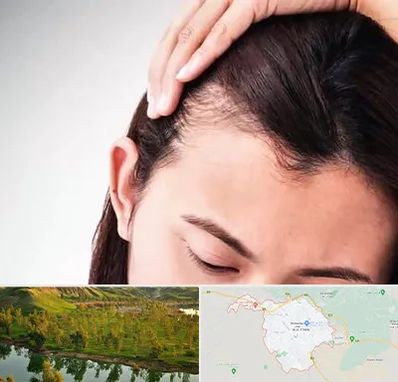 کاشت مو بانوان در بهبهان