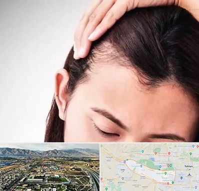 کاشت مو بانوان در منطقه 21 تهران 