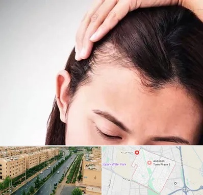 کاشت مو بانوان در فاز سه اندیشه