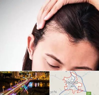 کاشت مو بانوان در سقز